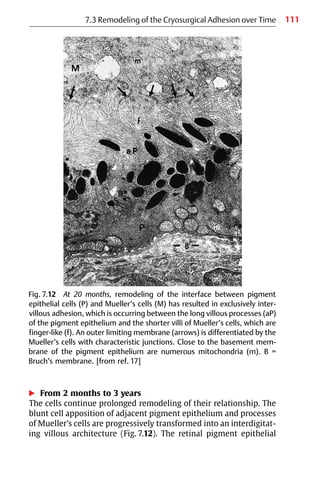 111
Fig. 7.12 At 20 months, remodeling of the interface between pigment
epithelial cells (P) and Mueller’s cells (M) has resulted in exclusively inter-
villous adhesion, which is occurring between the long villous processes (aP)
of the pigment epithelium and the shorter villi of Mueller’s cells, which are
finger-like (f). An outer limiting membrane (arrows) is differentiated by the
Mueller’s cells with characteristic junctions. Close to the basement mem-
brane of the pigment epithelium are numerous mitochondria (m). B =
Bruch’s membrane. [from ref. 17]
왘 From 2 months to 3 years
The cells continue prolonged remodeling of their relationship. The
blunt cell apposition of adjacent pigment epithelium and processes
of Mueller’s cells are progressively transformed into an interdigitat-
ing villous architecture (Fig. 7.12). The retinal pigment epithelial
7.3 Remodeling of the Cryosurgical Adhesion over Time
 