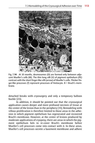 113
Fig. 7.14 At 30 months, desmosomes (D) are formed only between adja-
cent Mueller’s cells (M). The thin long villi (V) of pigment epithelium (PE)
contrast with the short finger-like villi (arrow) of Mueller’s cells. Thicker fin-
ger-like processes (f) represent processes of histiocyte. B = Bruch’s mem-
brane.
detached breaks with cryosurgery and only a temporary balloon
buckle [23].
In addition, it should be pointed out that the cryosurgical
application causes deeper and more profound necrosis of tissue at
the center of the lesion than in the periphery [15]. Remodeling with
villous proliferation is therefore limited to those areas in the adhe-
sion in which pigment epithelium has regenerated and recovered
Bruch’s membrane. However, at the center of lesions produced by
moderate applications of cryopexy, there are areas in which the pig-
ment epithelium fails to re-cover Bruch’s membrane before
Mueller’s cell processes come into contact with it. In these areas,
Mueller’s cell processes secrete a basement membrane and adhere
7.3 Remodeling of the Cryosurgical Adhesion over Time
 