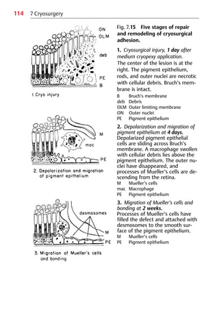 114
Fig. 7.15 Five stages of repair
and remodeling of cryosurgical
adhesion.
1. Cryosurgical injury, 1 day after
medium cryopexy application.
The center of the lesion is at the
right. The pigment epithelium,
rods, and outer nuclei are necrotic
with cellular debris. Bruch’s mem-
brane is intact.
B Bruch’s membrane
deb Debris
OLM Outer limiting membrane
ON Outer nuclei
PE Pigment epithelium
2. Depolarization and migration of
pigment epithelium at 4 days.
Depolarized pigment epithelial
cells are sliding across Bruch’s
membrane. A macrophage swollen
with cellular debris lies above the
pigment epithelium. The outer nu-
clei have disappeared, and
processes of Mueller’s cells are de-
scending from the retina.
M Mueller’s cells
mac Macrophage
PE Pigment epithelium
3. Migration of Mueller’s cells and
bonding at 2 weeks.
Processes of Mueller’s cells have
filled the defect and attached with
desmosomes to the smooth sur-
face of the pigment epithelium.
M Mueller’s cells
PE Pigment epithelium
7 Cryosurgery
 