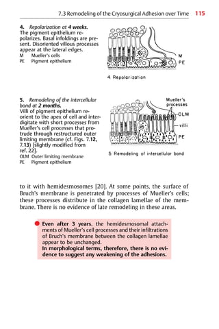115
4. Repolarization at 4 weeks.
The pigment epithelium re-
polarizes. Basal infoldings are pre-
sent. Disoriented villous processes
appear at the lateral edges.
M Mueller’s cells
PE Pigment epithelium
to it with hemidesmosomes [20]. At some points, the surface of
Bruch’s membrane is penetrated by processes of Mueller’s cells;
these processes distribute in the collagen lamellae of the mem-
brane. There is no evidence of late remodeling in these areas.
쎲 Even after 3 years, the hemidesmosomal attach-
ments of Mueller’s cell processes and their infiltrations
of Bruch’s membrane between the collagen lamellae
appear to be unchanged.
In morphological terms, therefore, there is no evi-
dence to suggest any weakening of the adhesions.
7.3 Remodeling of the Cryosurgical Adhesion over Time
5. Remodeling of the intercellular
bond at 2 months.
Villi of pigment epithelium re-
orient to the apex of cell and inter-
digitate with short processes from
Mueller’s cell processes that pro-
trude through restructured outer
limiting membrane (cf. Figs. 7.12,
7.13) [slightly modified from
ref. 22].
OLM Outer limiting membrane
PE Pigment epithelium
 