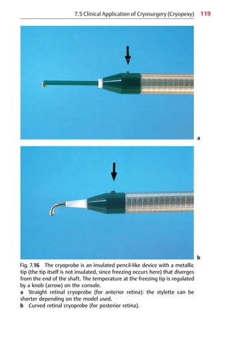 119
Fig. 7.16 The cryoprobe is an insulated pencil-like device with a metallic
tip (the tip itself is not insulated, since freezing occurs here) that diverges
from the end of the shaft. The temperature at the freezing tip is regulated
by a knob (arrow) on the console.
a Straight retinal cryoprobe (for anterior retina): the stylette can be
shorter depending on the model used.
b Curved retinal cryoprobe (for posterior retina).
a
b
7.5 Clinical Application of Cryosurgery (Cryopexy)
 