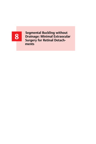 125
8
Segmental Buckling without
Drainage: Minimal Extraocular
Surgery for Retinal Detach-
ments
8 Segmental Buckling without Drainage
 