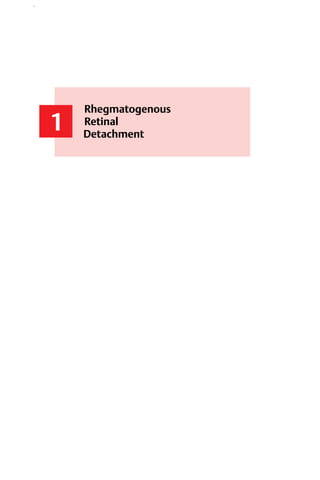 1
Rhegmatogenous
Retinal
Detachment
1
Rhegmatogenous
Retinal
Detachment
 