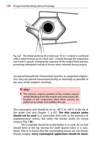 130
are placed beneath the 4 horizontal muscles. In unopened conjunc-
tiva, they are placed transconjunctivally as anteriorly as possible in
the area of the tendon’s insertion.
? Why?
왘 The extreme anterior position of the traction sutures
avoids bleeding from the muscle and unnecessary dis-
location of the conjunctiva when these sutures are
pulled on to rotate and stabilize the eye.
The cryosurgery unit should be set at −40 °C to −60 °C at the tip of
the probe (see also Chapter 7, p. 93). The thin cataract probe
should not be used (it is associated with risks in the presence of
staphylomatous sclera), but rather the thicker probe for retinal
surgery (Fig. 7.16).
The cryoprobe should be tested before it is used. An ice ball
should form at the tip, leaving the shaft spared (since it is insu-
lated). This is to insure that the surrounding tissues are not frozen.
During surgery, every cryosurgical application should be moni-
Fig. 8.2 The limbal peritomy (8 o’clock over 12 to 1 o’clock) is combined
with 2 radial incisions (at 8 o’clock and 1 o’clock) through the conjunctiva
and Tenon’s capsule, enlarging the exposure of the surgical field and thus
preventing subsequent tearing of tissues when retracted during surgery.
8 Segmental Buckling without Drainage
 