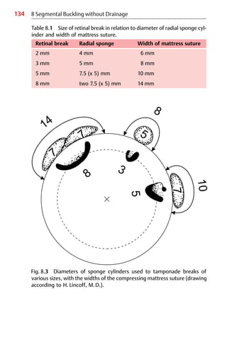134
Table 8.1 Size of retinal break in relation to diameter of radial sponge cyl-
inder and width of mattress suture.
Retinal break Radial sponge Width of mattress suture
2 mm 4 mm 6 mm
3 mm 5 mm 8 mm
5 mm 7.5 (x 5) mm 10 mm
8 mm two 7.5 (x 5) mm 14 mm
Fig. 8.3 Diameters of sponge cylinders used to tamponade breaks of
various sizes, with the widths of the compressing mattress suture (drawing
according to H. Lincoff, M.D.).
8 Segmental Buckling without Drainage
 