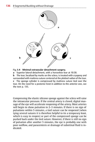 136
Compressing the elastic silicone sponge against the sclera will raise
the intraocular pressure. If the central artery is closed, digital mas-
sage of the eye will accelerate reopening of the artery. Most arteries
will begin to show pulsation in 2−3 minutes. If there is no sign of
pulsations within 5 minutes, a tied suture can be reopened (when
tying several sutures it is therefore helpful to tie a temporary knot,
which is easy to reopen) or part of the compressed sponge can be
pushed back under the tied suture. However, if there is still no sign
of pulsation after another 5 minutes, the eye is probably one with
poor outflow, and paracentesis or drainage of subretinal fluid is in-
dicated.
8 Segmental Buckling without Drainage
Fig. 8.4 Minimal extraocular detachment surgery.
a Superior lateral detachment, with a horseshoe tear at 10:30.
b The tear, localized by marks on the sclera, is treated with cryopexy and
surrounded with mattress suture centered at the plotted radian of the tear.
c The sponge cylinder is compressed by mattress suture tied over the
tear. On the need for a posterior knot in addition to the anterior one, see
the text p. 135.
a
c
b
 