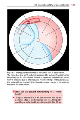 139
8.5 Orientation of the Segmental Buckle
Fig. 8.5a Inadequate tamponade of horseshoe tear in detachment.
The horseshoe tear at 11 o’clock is supported by a circumferential buckle
extending over 21/2 clock hours. The tear is supported anteriorly, but poste-
riorly it is leaking due to a fold causing “fishmouthing.” Without drainage,
the retina did not reattach; there is only a minor change in the anterior
border of the detachment.
? How can we prevent fishmouthing of a retinal
break?
왘 A logical approach is to fill the potential fold at the
posterior edge of the horseshoe tear—i.e., filling it by
providing a radial buckle as a tamponade (Fig. 8.5b).
 