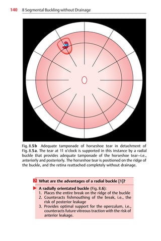 140 8 Segmental Buckling without Drainage
? What are the advantages of a radial buckle [1]?
왘 A radially orientated buckle (Fig. 8.6):
1. Places the entire break on the ridge of the buckle
2. Counteracts fishmouthing of the break, i.e., the
risk of posterior leakage
3. Provides optimal support for the operculum, i.e.,
counteracts future vitreous traction with the risk of
anterior leakage.
Fig. 8.5b Adequate tamponade of horseshoe tear in detachment of
Fig. 8.5a. The tear at 11 o’clock is supported in this instance by a radial
buckle that provides adequate tamponade of the horseshoe tear—i.e.,
anteriorly and posteriorly. The horseshoe tear is positioned on the ridge of
the buckle, and the retina reattached completely without drainage.
 