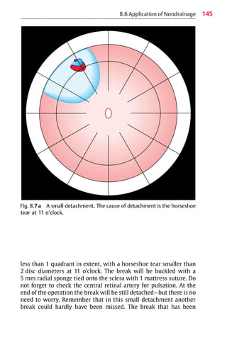 145
less than 1 quadrant in extent, with a horseshoe tear smaller than
2 disc diameters at 11 o’clock. The break will be buckled with a
5 mm radial sponge tied onto the sclera with 1 mattress suture. Do
not forget to check the central retinal artery for pulsation. At the
end of the operation the break will be still detached—but there is no
need to worry. Remember that in this small detachment another
break could hardly have been missed. The break that has been
8.6 Application of Nondrainage
Fig. 8.7a A small detachment. The cause of detachment is the horseshoe
tear at 11 o’clock.
 