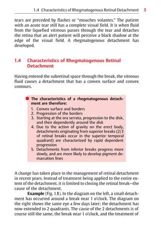 3
tears are preceded by flashes or “mouches volantes.” The patient
with an acute tear still has a complete visual field. It is when fluid
from the liquefied vitreous passes through the tear and detaches
the retina that an alert patient will perceive a black shadow at the
edge of the visual field. A rhegmatogenous detachment has
developed.
1.4 Characteristics of Rhegmatogenous Retinal
Detachment
Having entered the subretinal space through the break, the vitreous
fluid causes a detachment that has a convex surface and convex
contours.
쎲 The characteristics of a rhegmatogenous detach-
ment are therefore:
1. Convex surface and borders
2. Progression of the borders
3. Starting at the ora serrata, progression to the disk,
and then dependently around the disk
4. Due to the action of gravity on the erect body,
detachments originating from superior breaks (2/3
of retinal breaks occur in the superior temporal
quadrant) are characterized by rapid dependent
progression
5. Detachments from inferior breaks progress more
slowly, and are more likely to develop pigment de-
marcation lines
A change has taken place in the management of retinal detachment
in recent years. Instead of treatment being applied to the entire ex-
tent of the detachment, it is limited to closing the retinal break—the
cause of the detachment.
Example (Fig. 1.1). In the diagram on the left, a small detach-
ment has occurred around a break near 1 o’clock. The diagram on
the right shows the same eye a few days later; the detachment has
now extended to 2 quadrants. The cause of the 2 detachments is of
course still the same, the break near 1 o’clock, and the treatment of
1.4 Characteristics of Rhegmatogenous Retinal Detachment
 