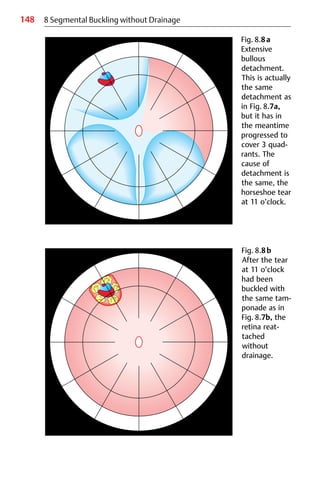 148
Fig. 8.8a
Extensive
bullous
detachment.
This is actually
the same
detachment as
in Fig. 8.7a,
but it has in
the meantime
progressed to
cover 3 quad-
rants. The
cause of
detachment is
the same, the
horseshoe tear
at 11 o’clock.
8 Segmental Buckling without Drainage
Fig. 8.8b
After the tear
at 11 o’clock
had been
buckled with
the same tam-
ponade as in
Fig. 8.7b, the
retina reat-
tached
without
drainage.
 