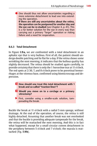149
8.6 Application of Nondrainage
쎲 One should thus not allow uncertainties regarding a
more extensive detachment to lead one into extend-
ing the operation.
If there are still any uncertainties about the retina,
the operation can be postponed for another day and
the eye can be re-studied (see Chapter 4, p. 41). This
is a far better solution for the eye in every way than
carrying out a primary “larger” operation or risking
failure and a need for reoperation.
8.6.3 Total Detachment
In Figure 8.9a, we are confronted with a total detachment in an
aphakic eye that is very bullous. First of all, the patient should un-
dergo double patching and lie flat for a day. If the retina shows some
wrinkling the next morning, it indicates that the bullous quality has
slightly decreased. The retina should be studied again carefully, to
provide certainty that there is only the 1 horseshoe tear at 11 o’clock.
The red spots at 2:30, 7, and 8 o’clock prove to be preretinal hemor-
rhages at the vitreous base, confirmed using biomicroscopy and de-
pression.
? How should one treat this total detachment with 1
break and so-called “traction lines“?
? Would you move on to a cerclage or a primary
vitrectomy?
왘 First, consider using a smaller-scale solution, tam-
ponading the break.
Buckle the break at 11 o’clock with a radial 5 mm sponge, without
drainage. At the end of the operation, of course, the retina is still
highly detached. Assuming that another break was not overlooked
and that the buckle is providing adequate tamponade for the break,
the retina will be reattached the next morning. And this is in fact
what happened, except for a small circular convex detachment in
the periphery between 5 o’clock and 7 o’clock; the macula is reat-
tached (Fig. 8.9b).
 