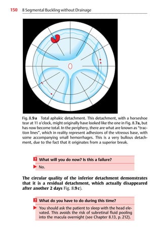 150
Fig. 8.9a Total aphakic detachment. This detachment, with a horseshoe
tear at 11 o’clock, might originally have looked like the one in Fig. 8.7a, but
has now become total. In the periphery, there are what are known as “trac-
tion lines”, which in reality represent adhesions of the vitreous base, with
some accompanying small hemorrhages. This is a very bullous detach-
ment, due to the fact that it originates from a superior break.
8 Segmental Buckling without Drainage
? What will you do now? Is this a failure?
왘 No.
The circular quality of the inferior detachment demonstrates
that it is a residual detachment, which actually disappeared
after another 2 days Fig. 8.9c).
? What do you have to do during this time?
왘 You should ask the patient to sleep with the head ele-
vated. This avoids the risk of subretinal fluid pooling
into the macula overnight (see Chapter 8.13, p. 212).
 