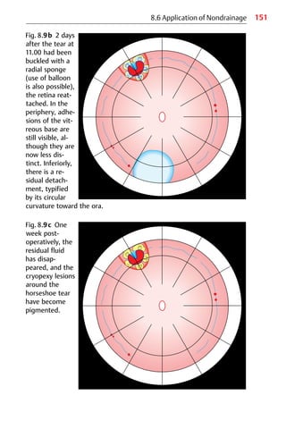 151
Fig. 8.9b 2 days
after the tear at
11.00 had been
buckled with a
radial sponge
(use of balloon
is also possible),
the retina reat-
tached. In the
periphery, adhe-
sions of the vit-
reous base are
still visible, al-
though they are
now less dis-
tinct. Inferiorly,
there is a re-
sidual detach-
ment, typified
by its circular
curvature toward the ora.
8.6 Application of Nondrainage
Fig. 8.9c One
week post-
operatively, the
residual fluid
has disap-
peared, and the
cryopexy lesions
around the
horseshoe tear
have become
pigmented.
 