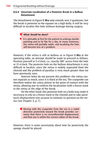 152 8 Segmental Buckling without Drainage
8.6.4 Uncertain Localization of a Posterior Break in a Bullous
Detachment
The detachment in Figure 8.10a only extends over 2 quadrants, but
the break is posterior to the equator on a high bulla. It will be very
difficult to localize this hole without drainage during surgery.
? What should be done?
왘 It is advisable at first for the patient to undergo double
patching and to lie flat for a day. In many instances,
the retina will partially settle, and localizing the hole
will become less of a problem.
However, if the retina is still as bullous as in Figure 8.10a at the
operating table, an attempt should be made to proceed as follows.
Position yourself at 5 o’clock, i.e., exactly 180° across from the hole
at 11 o’clock. The posterior hole on the bullous detachment is very
difficult to localize, since the retina is widely separated from the
choroid and the problem of parallax is very much greater than we
have previously seen.
Anterior holes do not present this problem—the retina can-
not separate as much, since it is fixed at the ora. The cryoprobe can
therefore indent the sclera almost to the point of contact with the
retina, allowing one to confirm the localization with a freeze mark
in the retina at the edge of the break.
On the other hand, this posterior hole on a bulla may make it
necessary to rely on a freeze mark in the choroid and to take paral-
lactic displacement into account to estimate its position on the ret-
ina (see Chapter 2, p. 7).
쎲 Moving with the cryoprobe from the ora in a radial
direction posteriorly toward the break provides cer-
tainty that there is no circumferential displacement,
and that one is within the correct radian of the break.
However, there is some uncertainty about how far posteriorly the
sponge should be placed.
 