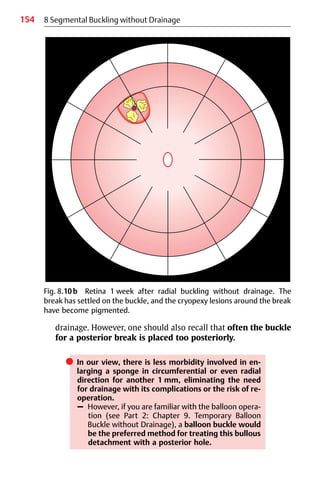 154 8 Segmental Buckling without Drainage
drainage. However, one should also recall that often the buckle
for a posterior break is placed too posteriorly.
쎲 In our view, there is less morbidity involved in en-
larging a sponge in circumferential or even radial
direction for another 1 mm, eliminating the need
for drainage with its complications or the risk of re-
operation.
– However, if you are familiar with the balloon opera-
tion (see Part 2: Chapter 9. Temporary Balloon
Buckle without Drainage), a balloon buckle would
be the preferred method for treating this bullous
detachment with a posterior hole.
Fig. 8.10b Retina 1 week after radial buckling without drainage. The
break has settled on the buckle, and the cryopexy lesions around the break
have become pigmented.
 