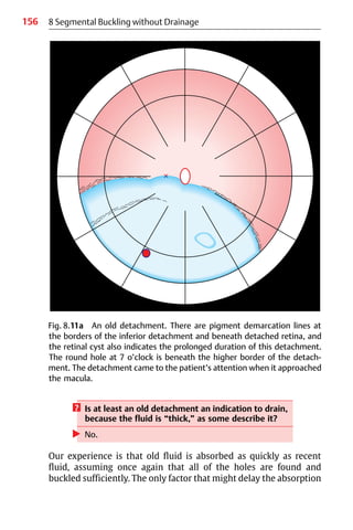 156 8 Segmental Buckling without Drainage
Fig. 8.11a An old detachment. There are pigment demarcation lines at
the borders of the inferior detachment and beneath detached retina, and
the retinal cyst also indicates the prolonged duration of this detachment.
The round hole at 7 o’clock is beneath the higher border of the detach-
ment. The detachment came to the patient’s attention when it approached
the macula.
? Is at least an old detachment an indication to drain,
because the fluid is “thick,” as some describe it?
왘 No.
Our experience is that old fluid is absorbed as quickly as recent
fluid, assuming once again that all of the holes are found and
buckled sufficiently. The only factor that might delay the absorption
 