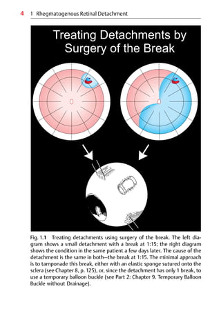 4
Fig. 1.1 Treating detachments using surgery of the break. The left dia-
gram shows a small detachment with a break at 1:15; the right diagram
shows the condition in the same patient a few days later. The cause of the
detachment is the same in both—the break at 1:15. The minimal approach
is to tamponade this break, either with an elastic sponge sutured onto the
sclera (see Chapter 8, p. 125), or, since the detachment has only 1 break, to
use a temporary balloon buckle (see Part 2: Chapter 9. Temporary Balloon
Buckle without Drainage).
1 Rhegmatogenous Retinal Detachment
 