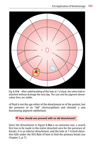 157
8.6 Application of Nondrainage
Fig. 8.11b After radial buckling of the hole at 7 o’clock, the retina had re-
attached without drainage the next day. The cyst and the pigment demar-
cation lines are visible.
of fluid is not the age either of the detachment or of the patient, but
the presence of an “old” choriocapillaris and choroid; a non
functioning pigment epithelium.
? How should one proceed with an old detachment?
Since the detachment in Figure 8.11a is an extensive one, a search
first has to be made in the entire detached area for the presence of
breaks. It is an inferior detachment, and the hole at 7 o’clock there-
fore falls under the 95% Rule of how to find the primary break (see
Chapter 2, p. 7).
 