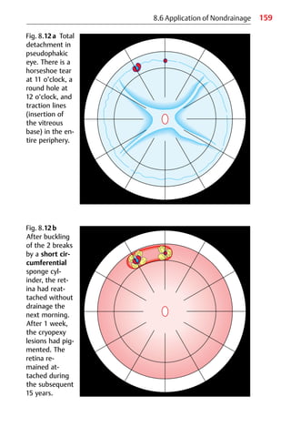 159
8.6 Application of Nondrainage
Fig. 8.12a Total
detachment in
pseudophakic
eye. There is a
horseshoe tear
at 11 o’clock, a
round hole at
12 o’clock, and
traction lines
(insertion of
the vitreous
base) in the en-
tire periphery.
Fig. 8.12b
After buckling
of the 2 breaks
by a short cir-
cumferential
sponge cyl-
inder, the ret-
ina had reat-
tached without
drainage the
next morning.
After 1 week,
the cryopexy
lesions had pig-
mented. The
retina re-
mained at-
tached during
the subsequent
15 years.
 