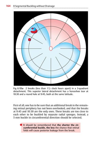164
First of all, one has to be sure that an additional break in the remain-
ing retinal periphery has not been overlooked, and that the breaks
at 9:45 and 10:30 are the only ones. These breaks are too close to
each other to be buckled by separate radial sponges. Instead, a
5 mm buckle in circumferential direction should be selected.
쎲 It should be remembered that the shorter the cir-
cumferential buckle, the less the chance that retinal
folds will cause posterior leakage from the break.
8 Segmental Buckling without Drainage
Fig. 8.13a 2 breaks (less than 11/2 clock hours apart) in a 3-quadrant
detachment. This superior lateral detachment has a horseshoe tear at
10:30 and a round hole at 9:45, both at the same latitude.
 