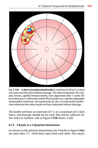 165
8.7 Optimal Tamponade for Multiple Breaks
Fig. 8.13b A short circumferential buckle (5 mm) from 9:30 to 11 o’clock
was sewn onto the sclera without drainage. The retina reattached. The cryo-
pexy lesions, applied intraoperatively, have pigmented after 1 week; the
horseshoe tear is sufficiently sealed off toward the ora, and also adequately
tamponaded (anteriorly and posteriorly) by the circumferential buckle—
since otherwise the retina would not have reattached without drainage.
The buckle will have an extension of 11/2 or a maximum of 2 clock
hours, and drainage should not be used. This will be sufficient for
the retina to reattach—and as Figure 8.13b shows, it did.
8.7.2 3 Breaks in a 3-Quadrant Detachment
In contrast to the previous detachment, the 3 breaks in Figure 8.14a
are more than 11/2 clock hours apart from each other. This means
 