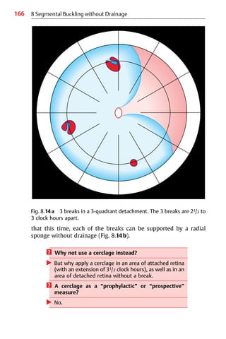 166
that this time, each of the breaks can be supported by a radial
sponge without drainage (Fig. 8.14b).
? Why not use a cerclage instead?
왘 But why apply a cerclage in an area of attached retina
(with an extension of 31/2 clock hours), as well as in an
area of detached retina without a break.
? A cerclage as a “prophylactic” or “prospective”
measure?
왘 No.
8 Segmental Buckling without Drainage
Fig. 8.14a 3 breaks in a 3-quadrant detachment. The 3 breaks are 21/2 to
3 clock hours apart.
 