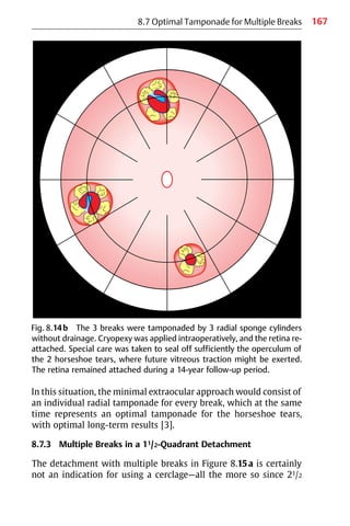 167
8.7 Optimal Tamponade for Multiple Breaks
In this situation, the minimal extraocular approach would consist of
an individual radial tamponade for every break, which at the same
time represents an optimal tamponade for the horseshoe tears,
with optimal long-term results [3].
8.7.3 Multiple Breaks in a 11/2-Quadrant Detachment
The detachment with multiple breaks in Figure 8.15a is certainly
not an indication for using a cerclage—all the more so since 21/2
Fig. 8.14b The 3 breaks were tamponaded by 3 radial sponge cylinders
without drainage. Cryopexy was applied intraoperatively, and the retina re-
attached. Special care was taken to seal off sufficiently the operculum of
the 2 horseshoe tears, where future vitreous traction might be exerted.
The retina remained attached during a 14-year follow-up period.
 