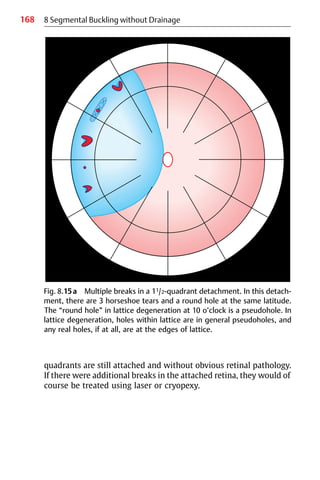 168
quadrants are still attached and without obvious retinal pathology.
If there were additional breaks in the attached retina, they would of
course be treated using laser or cryopexy.
8 Segmental Buckling without Drainage
Fig. 8.15a Multiple breaks in a 11/2-quadrant detachment. In this detach-
ment, there are 3 horseshoe tears and a round hole at the same latitude.
The “round hole” in lattice degeneration at 10 o’clock is a pseudohole. In
lattice degeneration, holes within lattice are in general pseudoholes, and
any real holes, if at all, are at the edges of lattice.
 