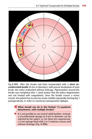 169
? What should one do in this limited 11/2-quadrant
detachment, with multiple breaks?
왘 It is not possible to use several radial buckles—instead,
a circumferential sponge of 4 mm in diameter can be
selected by the expert, or, for those less experienced,
a 5 mm sponge fixed with 2 or 3 mattress sutures and
without drainage (Fig. 8.15b).
8.7 Optimal Tamponade for Multiple Breaks
Fig. 8.15b After the breaks had been tamponaded with a short cir-
cumferential buckle (4 mm in diameter), with precise localization of each
break, the retina reattached without drainage. Pigmentation around the
breaks was completed after 1 week (notice that the lattice degeneration
was not treated with coagulation). Since the buckle crosses a rectus
muscle, the patient has to exercise ocular motility repeatedly starting day 1
postoperatively, in order to counteract postoperative diplopia.
 