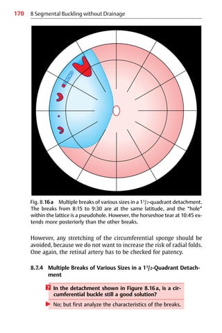 170 8 Segmental Buckling without Drainage
However, any stretching of the circumferential sponge should be
avoided, because we do not want to increase the risk of radial folds.
One again, the retinal artery has to be checked for patency.
8.7.4 Multiple Breaks of Various Sizes in a 11/2-Quadrant Detach-
ment
? In the detachment shown in Figure 8.16a, is a cir-
cumferential buckle still a good solution?
왘 No; but first analyze the characteristics of the breaks.
Fig. 8.16a Multiple breaks of various sizes in a 11/2-quadrant detachment.
The breaks from 8:15 to 9:30 are at the same latitude, and the “hole”
within the lattice is a pseudohole. However, the horseshoe tear at 10:45 ex-
tends more posteriorly than the other breaks.
 