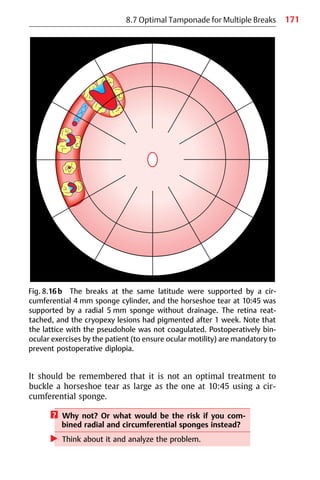 171
8.7 Optimal Tamponade for Multiple Breaks
It should be remembered that it is not an optimal treatment to
buckle a horseshoe tear as large as the one at 10:45 using a cir-
cumferential sponge.
? Why not? Or what would be the risk if you com-
bined radial and circumferential sponges instead?
왘 Think about it and analyze the problem.
Fig. 8.16b The breaks at the same latitude were supported by a cir-
cumferential 4 mm sponge cylinder, and the horseshoe tear at 10:45 was
supported by a radial 5 mm sponge without drainage. The retina reat-
tached, and the cryopexy lesions had pigmented after 1 week. Note that
the lattice with the pseudohole was not coagulated. Postoperatively bin-
ocular exercises by the patient (to ensure ocular motility) are mandatory to
prevent postoperative diplopia.
 