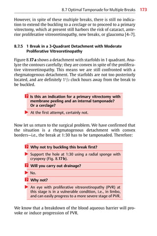 173
8.7 Optimal Tamponade for Multiple Breaks
However, in spite of these multiple breaks, there is still no indica-
tion to extend the buckling to a cerclage or to proceed to a primary
vitrectomy, which at present still harbors the risk of cataract, ante-
rior proliferative vitreoretinopathy, new breaks, or glaucoma [4−7].
8.7.5 1 Break in a 3-Quadrant Detachment with Moderate
Proliferative Vitreoretinopathy
Figure 8.17a shows a detachment with starfolds in 1 quadrant. Ana-
lyze the contours carefully; they are convex in spite of the prolifera-
tive vitreoretinopathy. This means we are still confronted with a
rhegmatogenous detachment. The starfolds are not too posteriorly
located, and are definitely 11/2 clock hours away from the break to
be buckled.
? Is this an indication for a primary vitrectomy with
membrane peeling and an internal tamponade?
Or a cerclage?
왘 At the first attempt, certainly not.
Now let us return to the surgical problem. We have confirmed that
the situation is a rhegmatogenous detachment with convex
borders—i.e., the break at 1:30 has to be tamponaded. Therefore:
? Why not try buckling this break first?
왘 Support the hole at 1:30 using a radial sponge with
cryopexy (Fig. 8.17b).
? Will you carry out drainage?
왘 No.
? Why not?
왘 An eye with proliferative vitreoretinopathy (PVR) at
this stage is in a vulnerable condition, i.e., in limbo,
and can easily progress to a more severe stage of PVR.
We know that a breakdown of the blood aqueous barrier will pro-
voke or induce progression of PVR.
 
