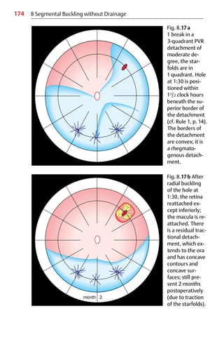 174 8 Segmental Buckling without Drainage
Fig. 8.17a
1 break in a
3-quadrant PVR
detachment of
moderate de-
gree, the star-
folds are in
1 quadrant. Hole
at 1:30 is posi-
tioned within
11/2 clock hours
beneath the su-
perior border of
the detachment
(cf. Rule 1, p. 14).
The borders of
the detachment
are convex; it is
a rhegmato-
genous detach-
ment.
Fig. 8.17b After
radial buckling
of the hole at
1:30, the retina
reattached ex-
cept inferiorly;
the macula is re-
attached. There
is a residual trac-
tional detach-
ment, which ex-
tends to the ora
and has concave
contours and
concave sur-
faces; still pre-
sent 2 months
postoperatively
(due to traction
of the starfolds).
 