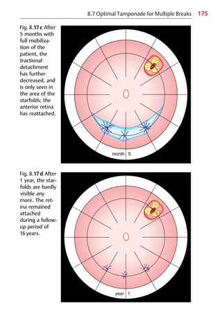 175
8.7 Optimal Tamponade for Multiple Breaks
Fig. 8.17c After
5 months with
full mobiliza-
tion of the
patient, the
tractional
detachment
has further
decreased, and
is only seen in
the area of the
starfolds; the
anterior retina
has reattached.
Fig. 8.17d After
1 year, the star-
folds are hardly
visible any
more. The ret-
ina remained
attached
during a follow-
up period of
16 years.
 