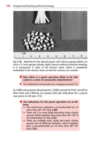182
? How often is a pouch operation likely to be indi-
cated in a series of consecutive detachments?
왘 The indication is extremely rare, ranging at around 1%.
In 2000 consecutive detachments (1000 treated by Prof. Lincoff in
New York and 1000 by our group [16]) the indication for a pouch
was given in 20 eyes (1%).
쎲 The indications for the pouch operation are as fol-
lows:
– The retinal tear subtends a circumferential arc of
more than 40°−70° (Fig. 8.20).
– There are 2 or more large horseshoe tears closely
spaced, which together span more than 40°−70° in
circumferential arc (Fig. 8.21).
– There are multiple tears, large and small, closely
spaced, but at different latitudes, which together
have a circumferential arc of more than 40°−70°
(Fig. 8.22).
8 Segmental Buckling without Drainage
Fig. 8.19 Materials for the silicone pouch. Left: silicone sponge pellets cut
from a 7.5 mm sponge cylinder. Right: Dacron-reinforced silicone sheeting;
it is transparent in spite of the Dacron mesh, which is completely
embedded in the silicone sheet so that the surfaces are smooth.
 