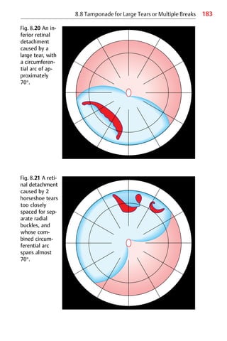 183
8.8 Tamponade for Large Tears or Multiple Breaks
Fig. 8.20 An in-
ferior retinal
detachment
caused by a
large tear, with
a circumferen-
tial arc of ap-
proximately
70°.
Fig. 8.21 A reti-
nal detachment
caused by 2
horseshoe tears
too closely
spaced for sep-
arate radial
buckles, and
whose com-
bined circum-
ferential arc
spans almost
70°.
 