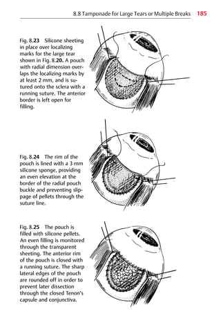 185
8.8 Tamponade for Large Tears or Multiple Breaks
Fig. 8.23 Silicone sheeting
in place over localizing
marks for the large tear
shown in Fig. 8.20. A pouch
with radial dimension over-
laps the localizing marks by
at least 2 mm, and is su-
tured onto the sclera with a
running suture. The anterior
border is left open for
filling.
Fig. 8.24 The rim of the
pouch is lined with a 3 mm
silicone sponge, providing
an even elevation at the
border of the radial pouch
buckle and preventing slip-
page of pellets through the
suture line.
Fig. 8.25 The pouch is
filled with silicone pellets.
An even filling is monitored
through the transparent
sheeting. The anterior rim
of the pouch is closed with
a running suture. The sharp
lateral edges of the pouch
are rounded off in order to
prevent later dissection
through the closed Tenon’s
capsule and conjunctiva.
 