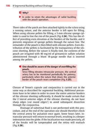 186 8 Segmental Buckling without Drainage
? Why?
왘 In order to retain the advantages of radial buckling
with the pouch operation.
Three sides of the patch are then attached tightly to the sclera using
a running suture, and the anterior border is left open for filling.
When using silicone pellets for filling, a 3 mm silicone sponge cyl-
inder is used to line the rim of the pouch (Fig. 8.24). This has the ef-
fect of providing even elevation at the borders of the buckle, and it
prevents migration of sponge pellets through the suture line. The
remainder of the pouch is then filled with silicone pellets. Even dis-
tribution of the pellets is facilitated by the transparency of the sili-
cone sheeting. Before the suture is finally tied, the contents of the
pouch are irrigated with 40 mg/ml of gentamicin sulfate solution
administered through a blunt 18-gauge needle that is inserted
among the pellets.
쎲 One should be aware of the danger of overfilling the
pouch.
Since filling elevates intraocular pressure, the central
artery has to be monitored periodically for patency,
particularly when the suture that closes the anterior
border of the pouch nears completion (Fig. 8.25).
Closure of Tenon’s capsule and conjunctiva is carried out in the
same way as described for segmental buckling. Additional precau-
tions have to be taken in order to cover the entire anterior borders
of the silicone sheeting sufficiently. It should be made certain that
the 2 lateral anterior edges of the silicone sheeting, do not have
sharp edges (cut round edges!) to avoid subsequent dissection
through the conjunctiva.
Drainage of subretinal fluid is not performed with this pro-
cedure, and at the end of the operation one should therefore check
the central artery for pulsation once again. Some hours later, in-
traocular pressure will return to normal levels, resulting in a deeper
indentation into the globe. If the localization was made precisely, all
of the breaks will be tamponaded and the retina will reattach
(Fig. 8.26).
 