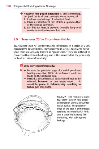 190 8 Segmental Buckling without Drainage
쎲 However, the pouch operation is time-consuming,
but (and this is all that counts) it works. Above, all:
1. It allows nondrainage of subretinal fluid.
2. It has a reattachment rate of 95%, as good as that
of the sponge operation.
3. Last but not least, it provides favorable long-term
results in relation to visual function.
8.9 Tears over 70° in Circumferential Arc
Tears larger than 70° are fortunately infrequent. In a series of 2000
consecutive detachments, they occurred in 0.4%. These large horse-
shoe tears are actually known as “giant tears.” They are difficult to
correct with external buckling, and if this is intended, they can only
be buckled circumferentially.
? Why only circumferentially?
왘 – Because the posterior edge of a radial pouch ex-
tending more than 70° in circumference would in-
trude on the posterior pole.
– Instead, a circumferential buckle would have to be
selected; however, as one might expect, this
would be prone to fishmouthing, resulting in
failure [20] (Fig. 8.27).
Fig. 8.27 The retina of a giant
tear (150°) is seen here under
compression using a circumfer-
ential buckle. The posterior
edge of the tear is compressed,
resulting in several radial folds
and a large fold causing fish-
mouthing, with subsequent
leakage.
 