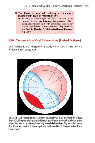 191
8.10 Tamponade of Oral Disinsertions (Retinal Dialyses)
Fig. 8.28 An old retinal detachment caused by an oral disinsertion of less
than 90°. The posterior edge of the tear has the same length as the anterior
edge, there is no additional tearing in radial direction. Pigment demarca-
tion lines and an intraretinal cyst are evidence that it has persisted for a
long period.
쎲 The limits of external buckling are therefore
reached with tears of more than 70°:
– Instead, an internal approach has to be selected as
treatment—i.e., an internal tamponade either
using gas or silicone oil, with or without vitrectomy
(for further details on the treatment of giant tears,
see Part 2: Chapter 10.6 Application of Expand-
ing Gases).
8.10 Tamponade of Oral Disinsertions (Retinal Dialyses)
Oral disinsertions are large retinal tears, which occur in less than 4%
of detachments (Fig. 8.28).
 