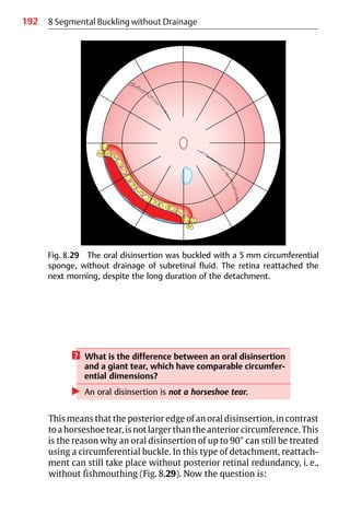 192 8 Segmental Buckling without Drainage
Fig. 8.29 The oral disinsertion was buckled with a 5 mm circumferential
sponge, without drainage of subretinal fluid. The retina reattached the
next morning, despite the long duration of the detachment.
? What is the difference between an oral disinsertion
and a giant tear, which have comparable circumfer-
ential dimensions?
왘 An oral disinsertion is not a horseshoe tear.
This means that the posterior edge of an oral disinsertion, in contrast
to a horseshoe tear, is not larger than the anterior circumference. This
is the reason why an oral disinsertion of up to 90° can still be treated
using a circumferential buckle. In this type of detachment, reattach-
ment can still take place without posterior retinal redundancy, i. e.,
without fishmouthing (Fig. 8.29). Now the question is:
 