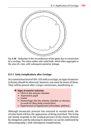 199
8.11.1 Early Complications after Cerclage
At a constriction level of 10%−15% with a cerclage, no signs of anterior
ischemia should be observed; however, one must be aware of these.
They will be present after a larger constriction, manifesting as:
쎲 Signs of anterior ischemia:
– Fibrin in the anterior chamber
– Asymmetric pupil
– Uveitis
– Hemorrhage into the anterior chamber or vitreous
(a result of ciliary body constriction)
– Hypertension or hypotension (choroidals, phthisis).
Although intraocular pressure has returned to normal levels, the
circular band still has the appearance of being stretched. The living
eye slowly responds to the residual pressure of the elastic element
by elongation and by reducing its diameter (as can be confirmed by
ultrasonography), with subsequent complications.
8.11 Application of Cerclage
Fig. 8.30 Reduction in the circumference of the globe due to constriction
by a cerclage. The retina settles with radial folds, which often aggregate in
the area of a tear, with subsequent posterior leakage.
 