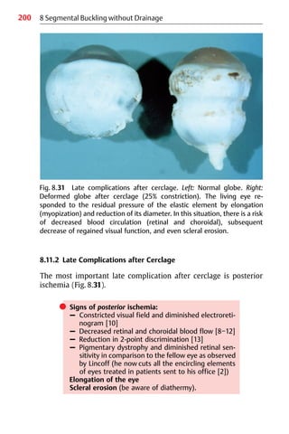 200
8.11.2 Late Complications after Cerclage
The most important late complication after cerclage is posterior
ischemia (Fig. 8.31).
쎲 Signs of posterior ischemia:
– Constricted visual field and diminished electroreti-
nogram [10]
– Decreased retinal and choroidal blood flow [8−12]
– Reduction in 2-point discrimination [13]
– Pigmentary dystrophy and diminished retinal sen-
sitivity in comparison to the fellow eye as observed
by Lincoff (he now cuts all the encircling elements
of eyes treated in patients sent to his office [2])
Elongation of the eye
Scleral erosion (be aware of diathermy).
8 Segmental Buckling without Drainage
Fig. 8.31 Late complications after cerclage. Left: Normal globe. Right:
Deformed globe after cerclage (25% constriction). The living eye re-
sponded to the residual pressure of the elastic element by elongation
(myopization) and reduction of its diameter. In this situation, there is a risk
of decreased blood circulation (retinal and choroidal), subsequent
decrease of regained visual function, and even scleral erosion.
 
