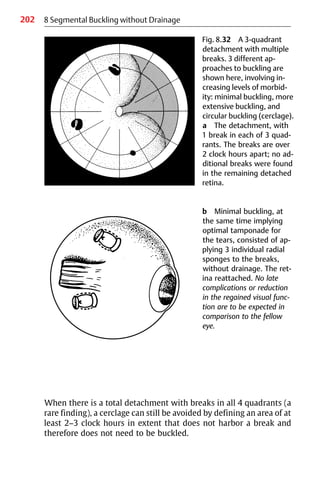 202 8 Segmental Buckling without Drainage
Fig. 8.32 A 3-quadrant
detachment with multiple
breaks. 3 different ap-
proaches to buckling are
shown here, involving in-
creasing levels of morbid-
ity: minimal buckling, more
extensive buckling, and
circular buckling (cerclage).
a The detachment, with
1 break in each of 3 quad-
rants. The breaks are over
2 clock hours apart; no ad-
ditional breaks were found
in the remaining detached
retina.
b Minimal buckling, at
the same time implying
optimal tamponade for
the tears, consisted of ap-
plying 3 individual radial
sponges to the breaks,
without drainage. The ret-
ina reattached. No late
complications or reduction
in the regained visual func-
tion are to be expected in
comparison to the fellow
eye.
When there is a total detachment with breaks in all 4 quadrants (a
rare finding), a cerclage can still be avoided by defining an area of at
least 2−3 clock hours in extent that does not harbor a break and
therefore does not need to be buckled.
 