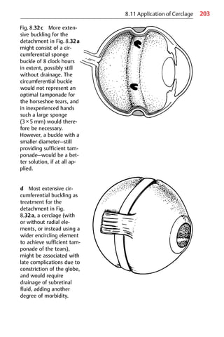 203
8.11 Application of Cerclage
Fig. 8.32c More exten-
sive buckling for the
detachment in Fig. 8.32a
might consist of a cir-
cumferential sponge
buckle of 8 clock hours
in extent, possibly still
without drainage. The
circumferential buckle
would not represent an
optimal tamponade for
the horseshoe tears, and
in inexperienced hands
such a large sponge
(3 × 5 mm) would there-
fore be necessary.
However, a buckle with a
smaller diameter—still
providing sufficient tam-
ponade—would be a bet-
ter solution, if at all ap-
plied.
d Most extensive cir-
cumferential buckling as
treatment for the
detachment in Fig.
8.32a, a cerclage (with
or without radial ele-
ments, or instead using a
wider encircling element
to achieve sufficient tam-
ponade of the tears),
might be associated with
late complications due to
constriction of the globe,
and would require
drainage of subretinal
fluid, adding another
degree of morbidity.
 