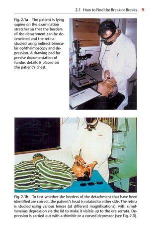 9
Fig. 2.1a The patient is lying
supine on the examination
stretcher so that the borders
of the detachment can be de-
termined and the retina
studied using indirect binocu-
lar ophthalmoscopy and de-
pression. A drawing pad for
precise documentation of
fundus details is placed on
the patient’s chest.
Fig. 2.1b To test whether the borders of the detachment that have been
identified are correct, the patient’s head is rotated to either side. The retina
is studied using various lenses (at different magnifications), with simul-
taneous depression via the lid to make it visible up to the ora serrata. De-
pression is carried out with a thimble or a curved depressor (see Fig. 2.3).
2.1 How to Find the Break or Breaks
 