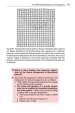 211
8.12 Retinal Detachment: An Emergency
Fig. 8.33 Postoperative Amsler grid in a 39-year old patient after repair of
an inferior detachment (oral disinsertion) that appeared for treatment
when the macula detached. Postoperatively, the patient had a visual acuity
of 20/20 and no detectable color vision disturbances. However, there was a
superior wedge of distortion in the Amsler grid that correlated with the
previous extent of the macular detachment. The remainder of the grid was
unaffected.
? Which of these findings have important implica-
tions for the clinical management of detachment
patients?
왘 Apart from the prognosis in retinal reattachment, the
implications for clinical management are as follows:
– While neither the age of the patient nor the myopia
can be influenced by treatment
– The extent and duration of a macular detach-
ment can be modified by immediate hospitaliza-
tion of the patient — all the more so when treating
a patient with a macular detachment
쐌 that has persisted for less than 1 week, or which
is in
쐌 patients over 60 years of age or in
쐌 myopes over −6 dpt.
 