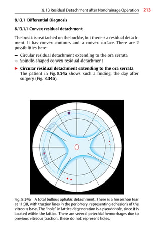 213
8.13.1 Differential Diagnosis
8.13.1.1 Convex residual detachment
The break is reattached on the buckle, but there is a residual detach-
ment. It has convex contours and a convex surface. There are 2
possibilities here:
– Circular residual detachment extending to the ora serrata
– Spindle-shaped convex residual detachment
왘 Circular residual detachment extending to the ora serrata
The patient in Fig. 8.34a shows such a finding, the day after
surgery (Fig. 8.34b).
8.13 Residual Detachment after Nondrainage Operation
Fig. 8.34a A total bullous aphakic detachment. There is a horseshoe tear
at 11:30, with traction lines in the periphery, representing adhesions of the
vitreous base. The “hole” in lattice degeneration is a pseudohole, since it is
located within the lattice. There are several petechial hemorrhages due to
previous vitreous traction; these do not represent holes.
 