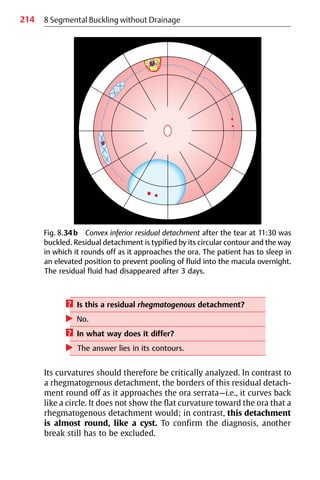 214 8 Segmental Buckling without Drainage
? Is this a residual rhegmatogenous detachment?
왘 No.
? In what way does it differ?
왘 The answer lies in its contours.
Its curvatures should therefore be critically analyzed. In contrast to
a rhegmatogenous detachment, the borders of this residual detach-
ment round off as it approaches the ora serrata—i.e., it curves back
like a circle. It does not show the flat curvature toward the ora that a
rhegmatogenous detachment would; in contrast, this detachment
is almost round, like a cyst. To confirm the diagnosis, another
break still has to be excluded.
Fig. 8.34b Convex inferior residual detachment after the tear at 11:30 was
buckled. Residual detachment is typified by its circular contour and the way
in which it rounds off as it approaches the ora. The patient has to sleep in
an elevated position to prevent pooling of fluid into the macula overnight.
The residual fluid had disappeared after 3 days.
 